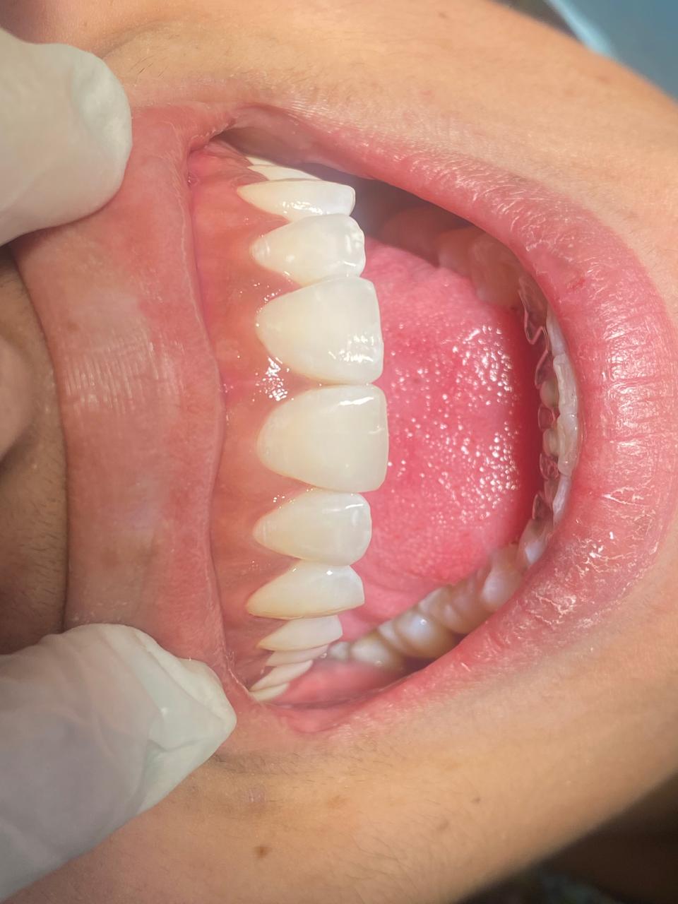 Depois do tratamento